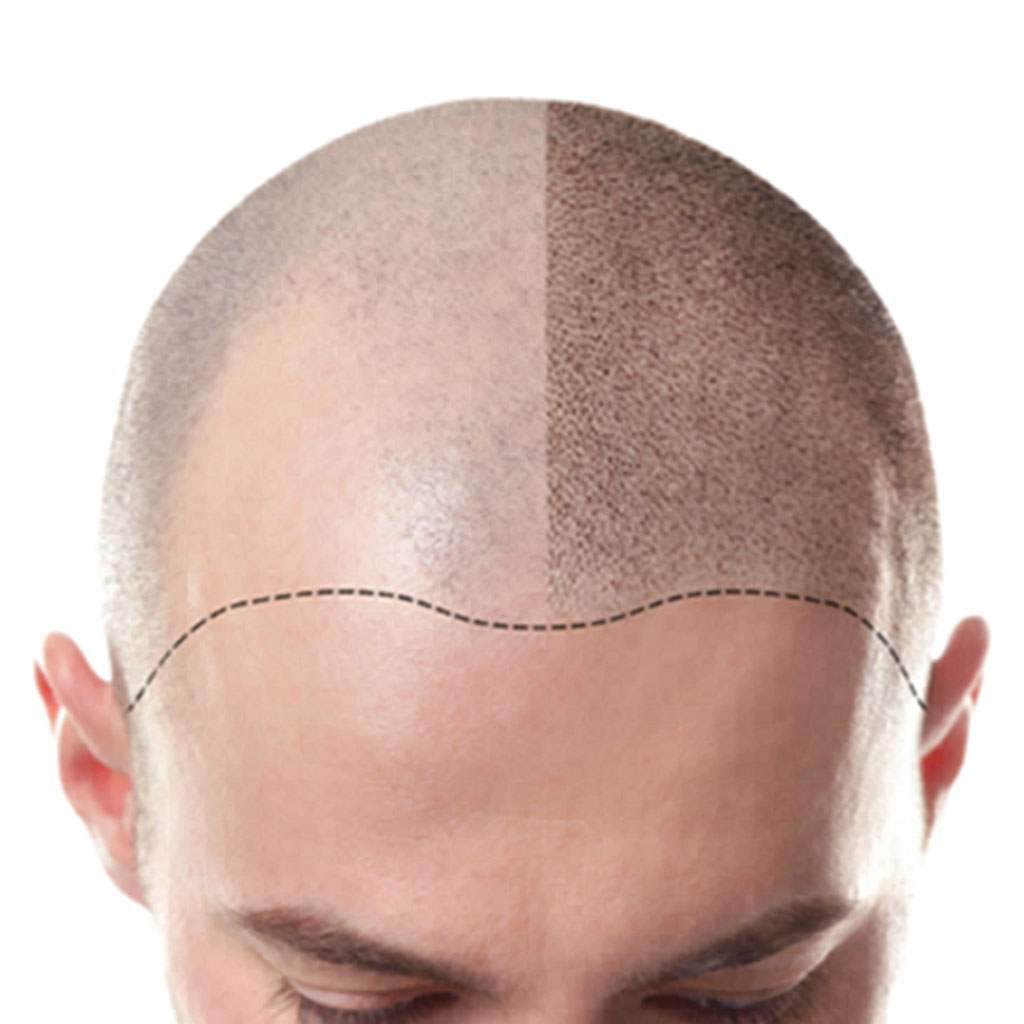 Before and after tricopigmentation on a shaved scalp, showcasing the transformation from visible hair loss to a fuller, natural-looking appearance.